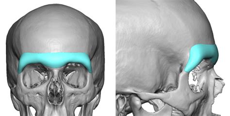 Custom Brow Bone Implant Design Dr Barry Eppley Indianapolis - Explore ...