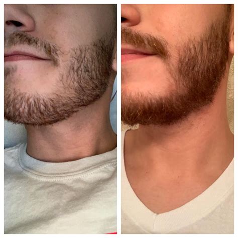 Patchy beard. Will the patch go away ? 18 days vs 40 days | Patchy ...