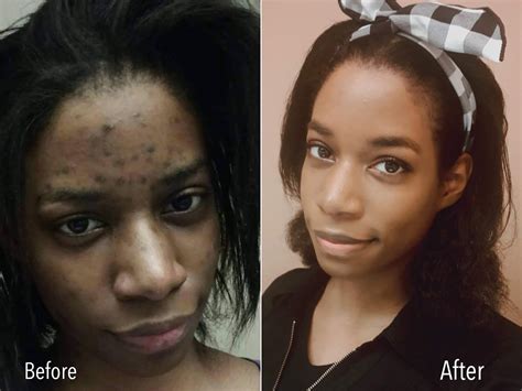 Black People Acne Scars Before And After