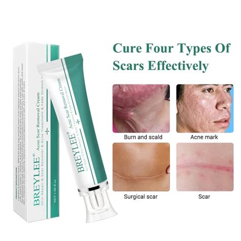 Acne Scar Removal Cream 30g Face Cream Skin Repair Skin Care Scar Acne ...