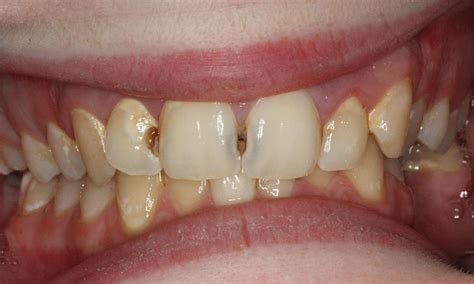 Anterior White Fillings Before & After Photos | Lead SD