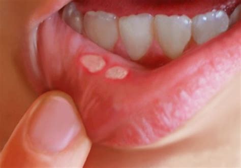 Blisters in Mouth - Symptoms, Treatment, Causes, Pictures | hubpages