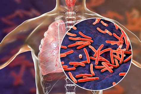 Tuberculosis: Symptoms, Treatment & Prevention | Live Science