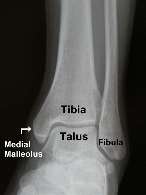 Ankle Fracture - FootEducation