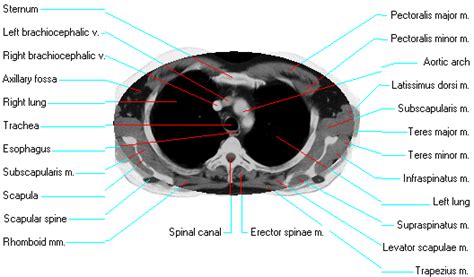 Ct Thorax Anatomy - Anatomical Charts & Posters