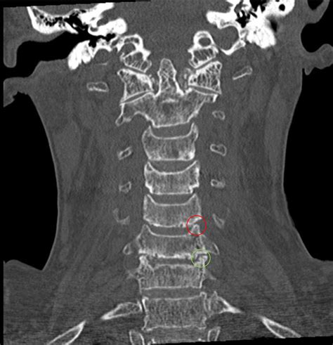 Subaxial Cervical Spine CT | Radiology Key