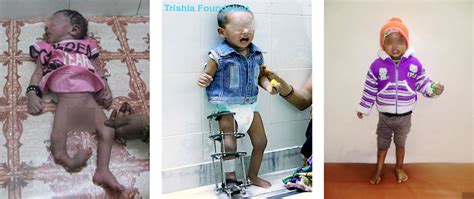 Hemiplegic Cerebral Palsy Treatment India, Nepal, Bangladesh, Africa ...