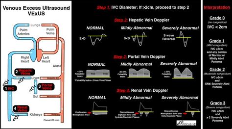 VExUS Ultrasound Score – Fluid Overload and Venous Congestion ...