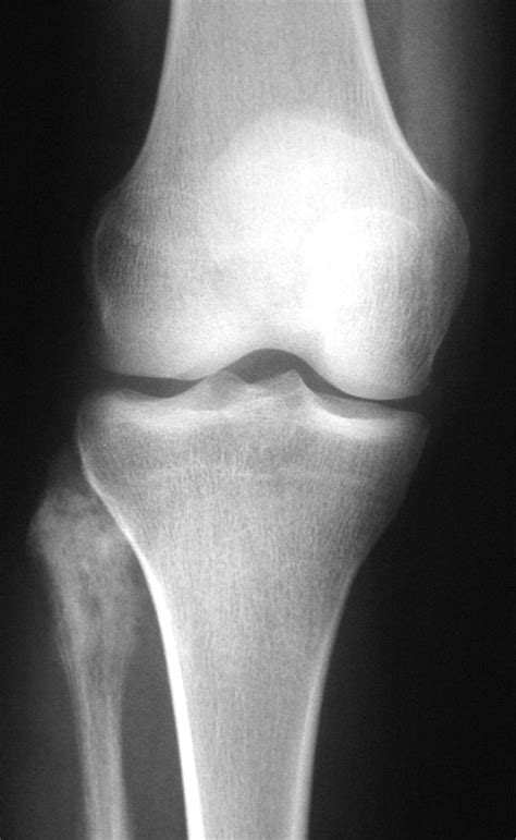 Osteosarcoma Radiology