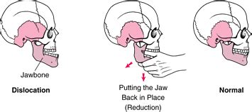 My Family Medicine Practice: Jaw dislocation or fracture