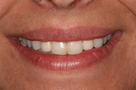 Replacing Missing Front Teeth with Implants - PureCare Dental