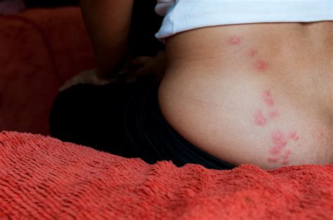 Bed Bug Bites Pictures, Symptoms: What Do Bed Bug Bites