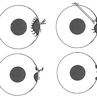 Surgical techniques. (a) Interrupted incisions of the sclera were done ...