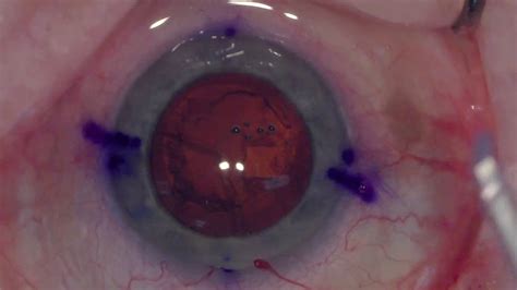 Cost of toric lenses for cataract surgery