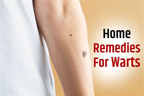 Wart Removal: 5 Effective Natural Remedies To Treat Warts at Home