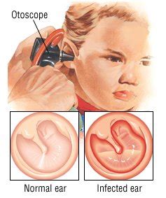 Middle-Ear Infection (Otitis Media) Guide: Causes, Symptoms and ...