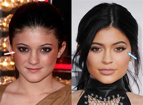 Kylie Jenner Before and after: Nose Job, Lip Injections, Breast