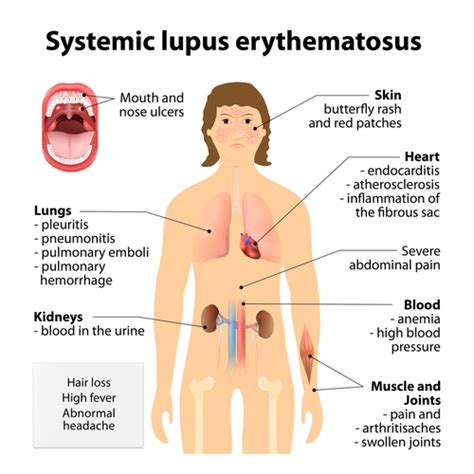 Lupus Symptoms - Lupus News Today