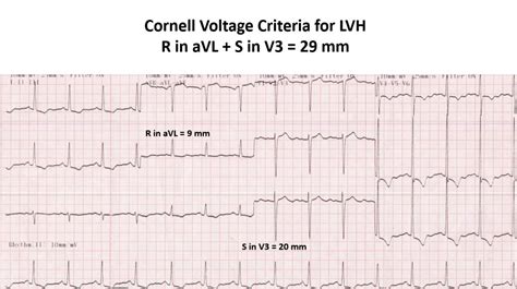 Cornell voltage criteria for LVH – All About Cardiovascular System and ...