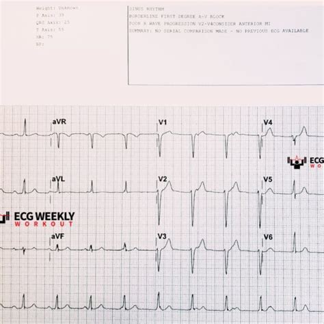 Isorhythmic AV dissociation – ECG Weekly