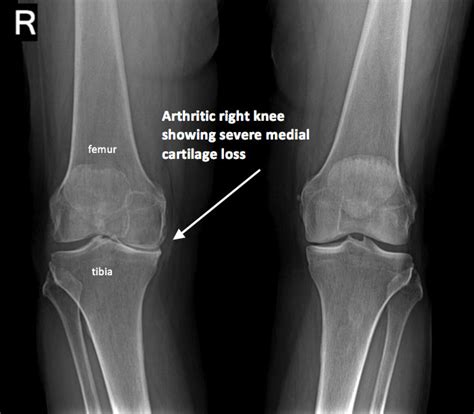 Knee Xray - Upper West Side, Columbus Circle New York, NY