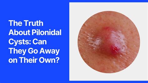 What is a Pilonidal Cyst? - Pilonidal Institute