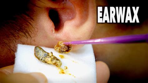 THE BEST EARWAX REMOVAL EVER! (and most gross) | Dr. Paul - YouTube