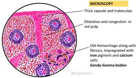 Chronic Venous Congestion : Spleen - Pathology Made Simple