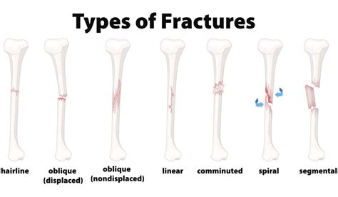 Understanding the Different Types of Bone Fractures - Comprehensive ...