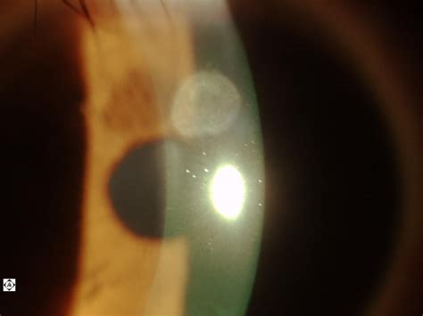 Sonoran Desert Eye Center: SCAR FROM CONTACT LENS RELATED CORNEAL ULCER