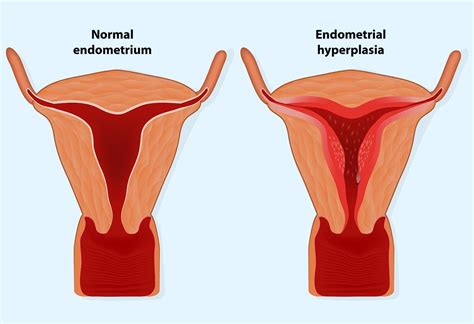 Endometrial Thickness: What’s the Normal Range for Conceiving?