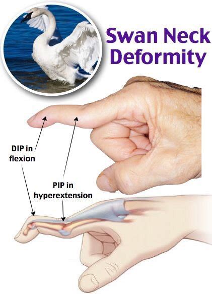 What I learned today - Hand Deformities | Medical Amino