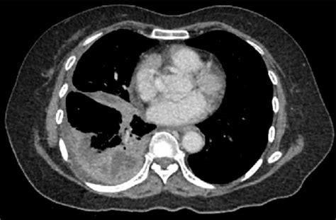 Axial CT scan with contrast of the lower thorax on re-admission.The ...