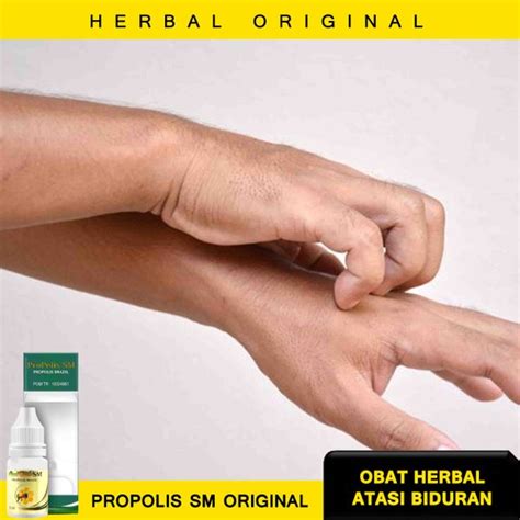 Jual Obat Biduran Menahun - Obat Biduran - Obat Biduran Herbal - Obat ...