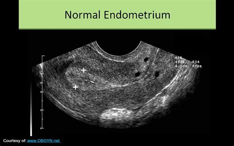 Pelvic Ultrasound: Endometrial Thickness Pelvic Ultrasound