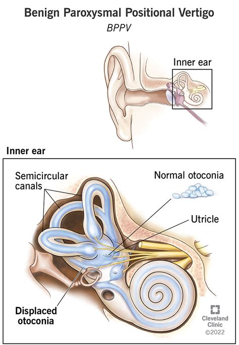 Benign Paroxysmal Positional Vertigo (BPPV) - Cleveland Clinic