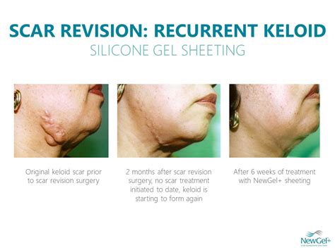 Before & After Photos - Clinically Proven Silicone Scar Treatment