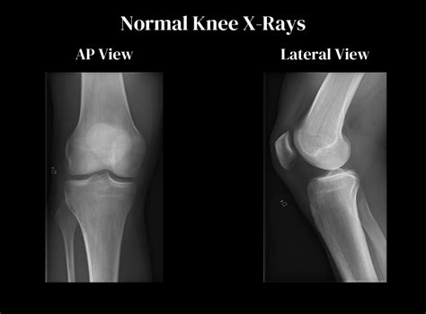 ACL Tear Treatment In San Jose, CA | Dr. Pamela Mehta, MD