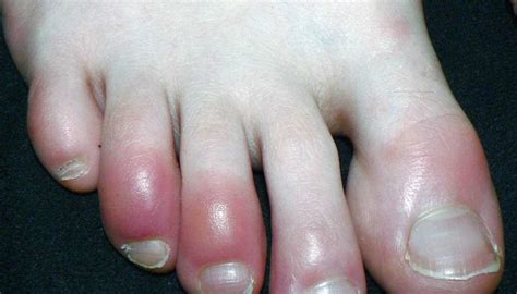 Why are my toes red? Causes, other symptoms, and treatments