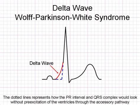 delta wave ecg