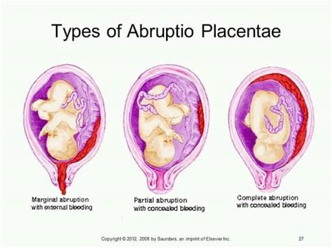 Placental Abruption - Symptoms, Complications & Treatment - Santripty