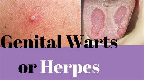 Genital warts treatment 18 video warts how neck best – Artofit