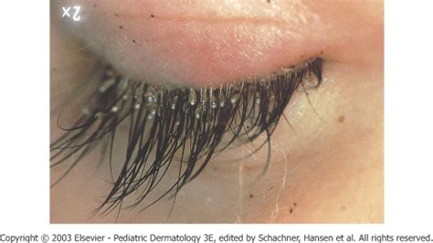 26 New What Causes Eyelash Lice - Demodectic Mange