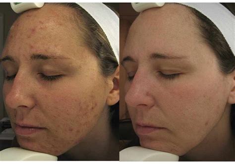 Laser Acne Treatment Expert of East Brunswick, Central New Jersey