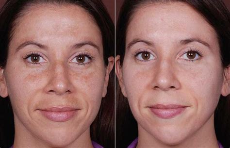 Contour Dermatology – Melasma treatment results with Obagi NuDerm Kit ...