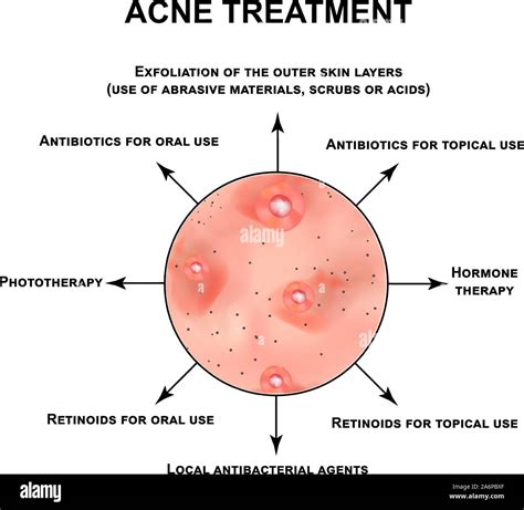 Acne treatment. Pustules, papules, comedones, blackheads, acne on the ...