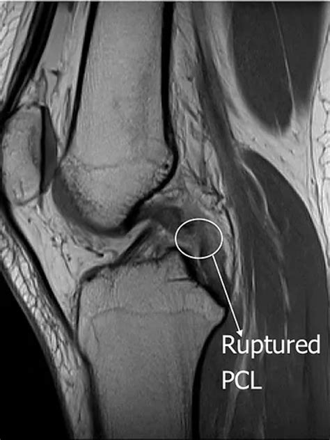 PCL & Multi-ligament Reconstruction