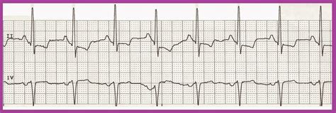 Practice EKG Rhythm Strips 216