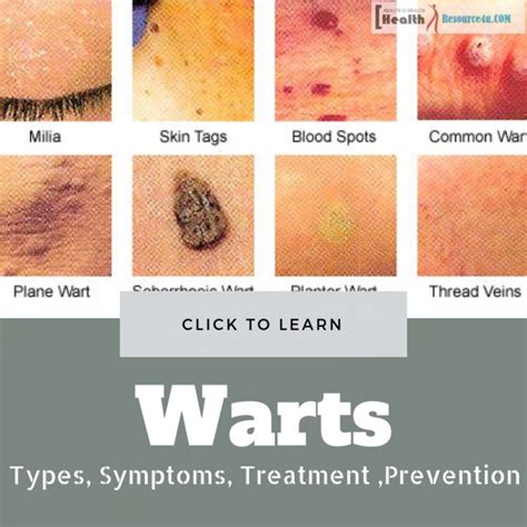 Warts Types, Symptoms, Treatment And Its Preventing Measures