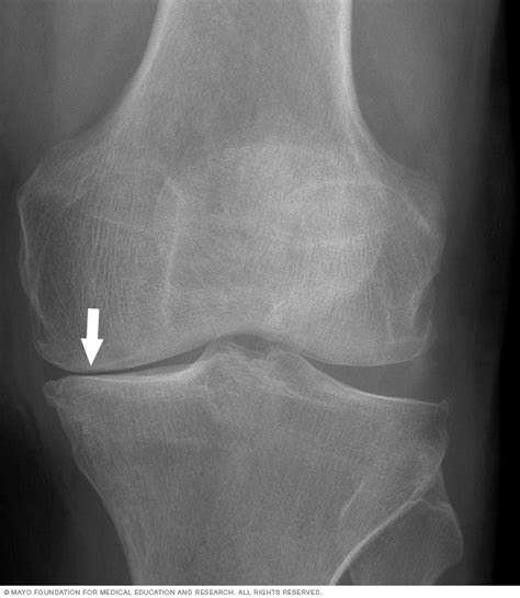 X-ray of knee arthritis - Mayo Clinic